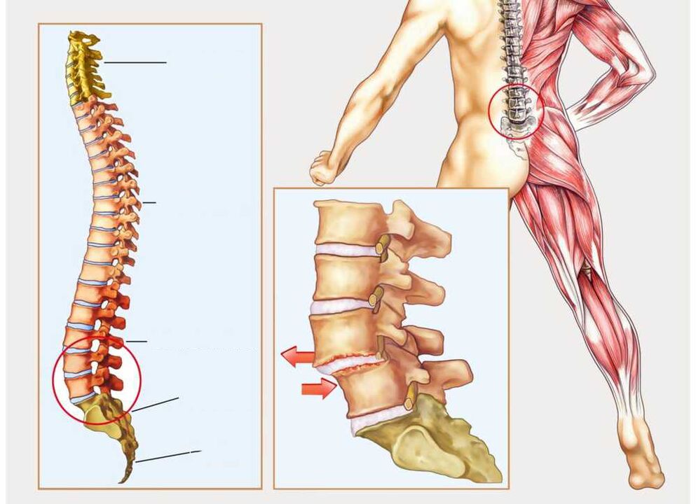 υγιής και άρρωστη σπονδυλική στήλη