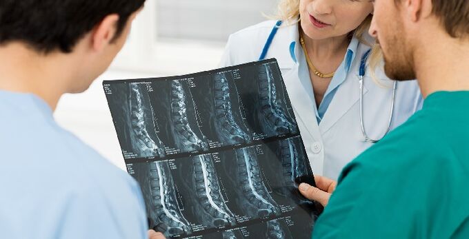 Ακτινογραφία της σπονδυλικής στήλης που χρησιμοποιείται για τη διάγνωση της οστεοχόνδρωσης
